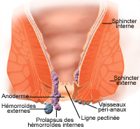 Cabinet St Raphael - Hémorroïdes : externes ou internes ? Les hémorroïdes  externes Elles apparaissent sous la peau à l'orifice de l'anus. Elles  peuvent causer une enflure dans la région. Elles sont